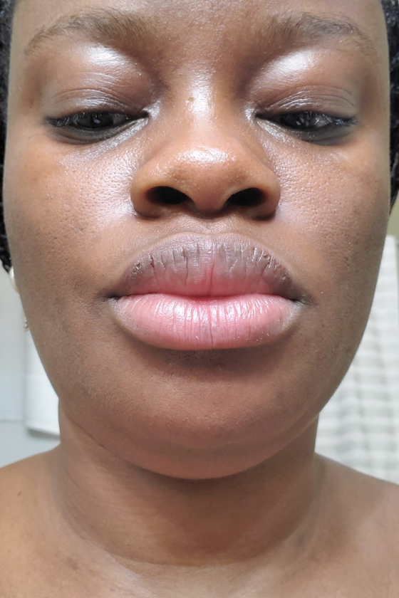 Lip Balm